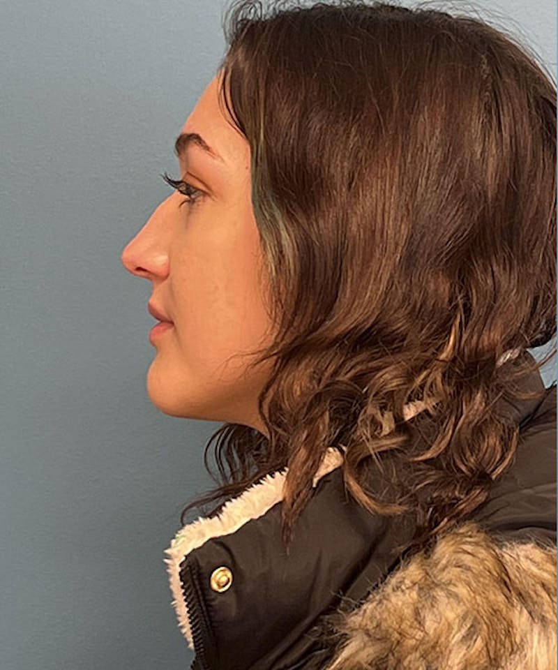 Rhinoplasty Before & After Gallery - Patient 951890 - Image 1