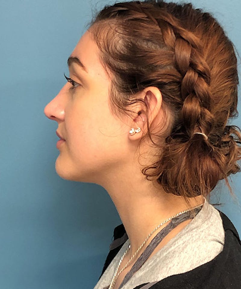 Rhinoplasty Before & After Gallery - Patient 951890 - Image 2
