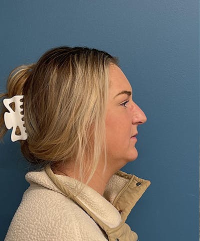 Rhinoplasty Before & After Gallery - Patient 233918 - Image 1