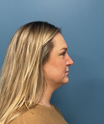 Rhinoplasty Before & After Gallery - Patient 233918 - Image 2