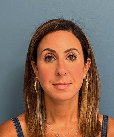 Rhinoplasty Before & After Gallery - Patient 144769 - Image 1