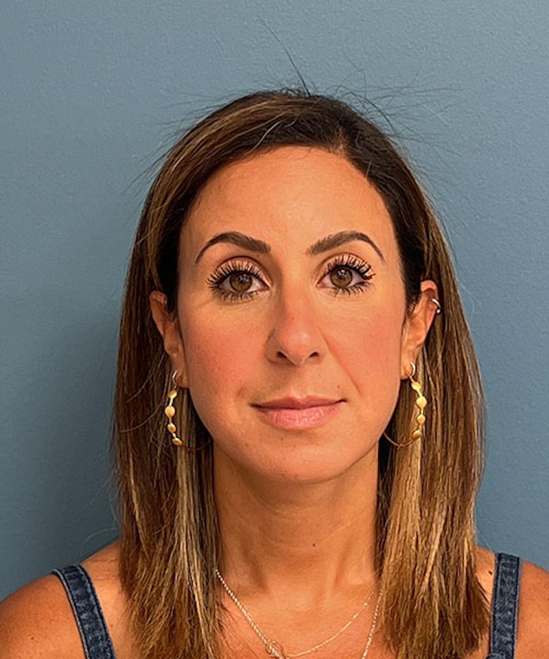 Rhinoplasty Before & After Gallery - Patient 144769 - Image 1