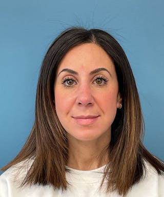 Rhinoplasty Before & After Gallery - Patient 144769 - Image 2