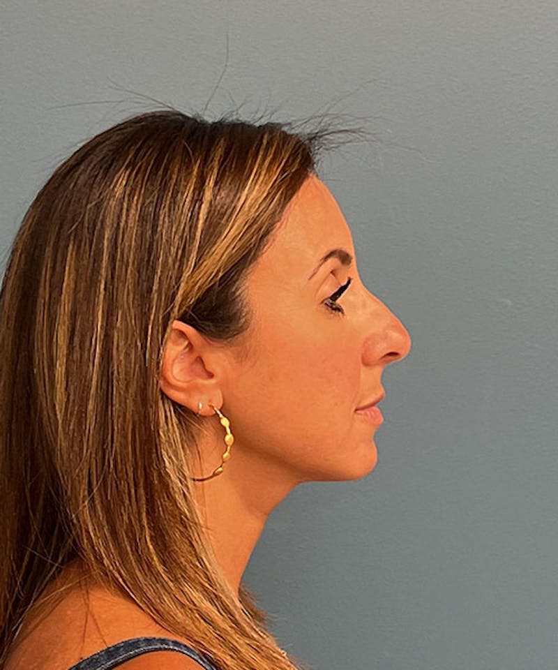 Rhinoplasty Before & After Gallery - Patient 144769 - Image 3