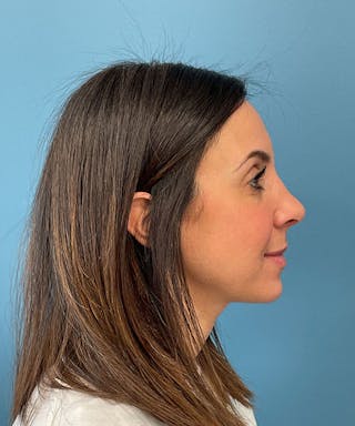 Rhinoplasty Before & After Gallery - Patient 144769 - Image 4