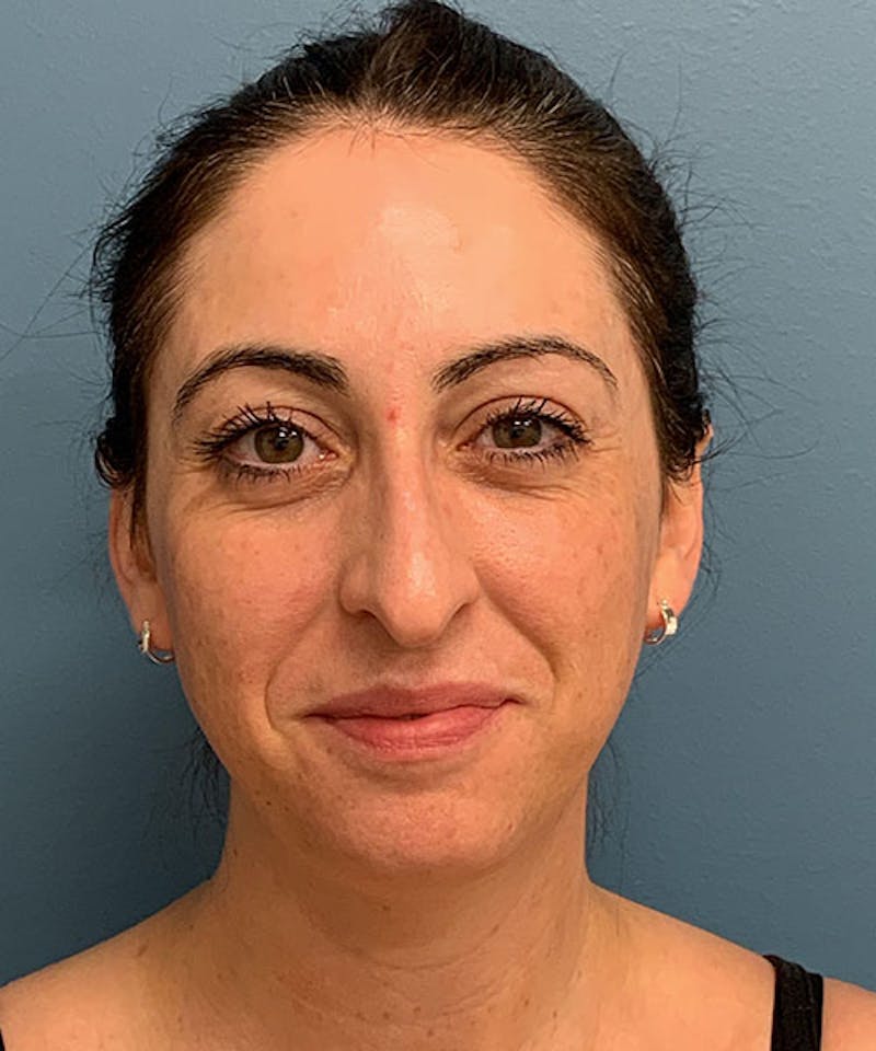 Rhinoplasty Before & After Gallery - Patient 236953 - Image 1