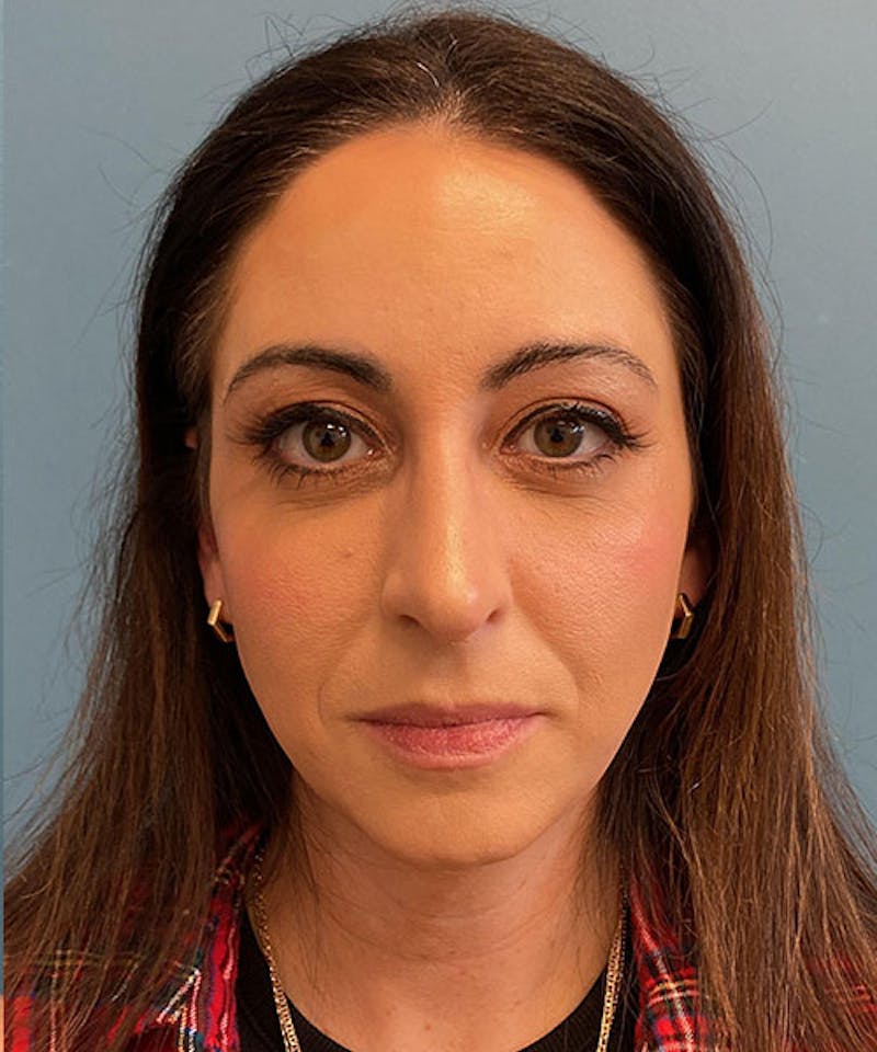 Rhinoplasty Before & After Gallery - Patient 236953 - Image 2