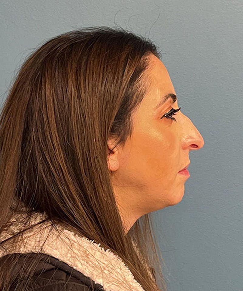 Rhinoplasty Before & After Gallery - Patient 236953 - Image 3
