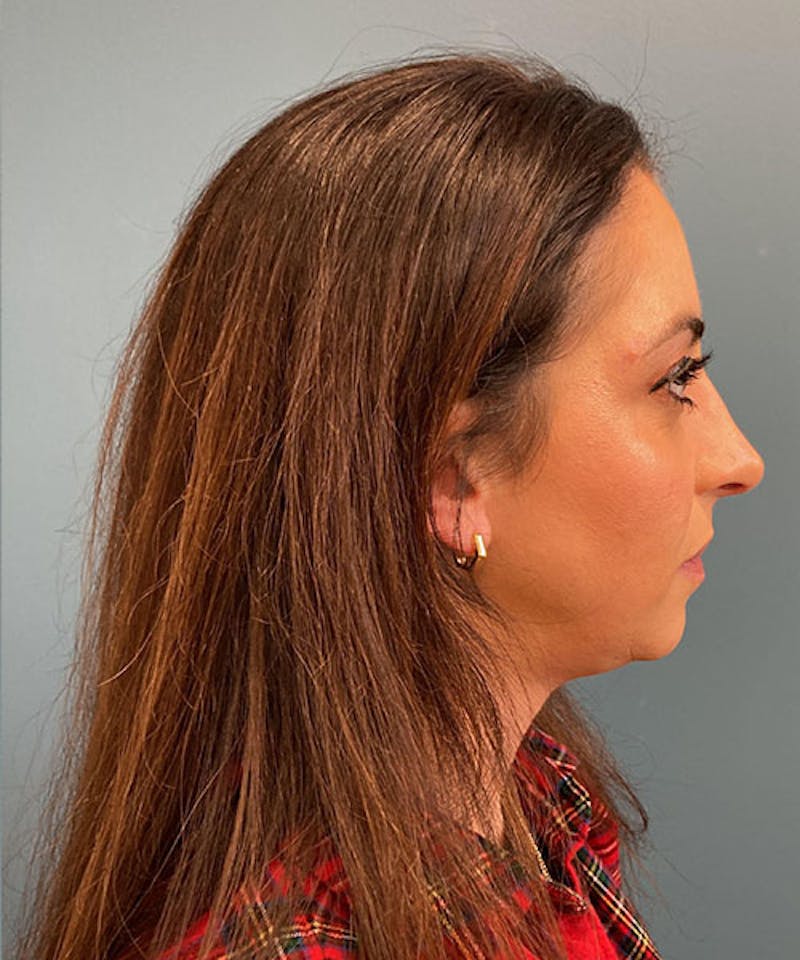 Rhinoplasty Before & After Gallery - Patient 236953 - Image 4