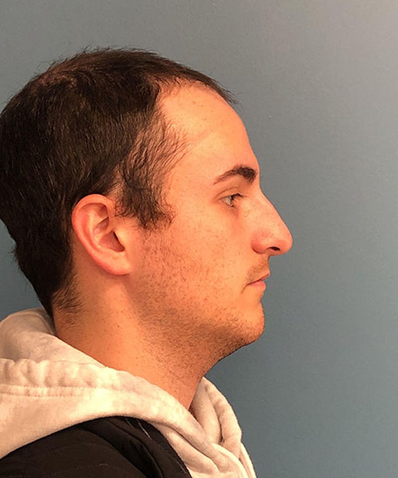 Rhinoplasty Before & After Gallery - Patient 345265 - Image 1