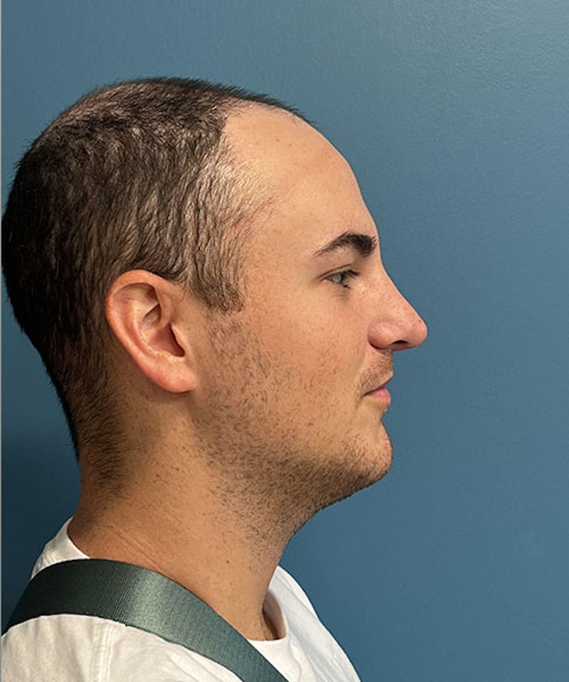 Rhinoplasty Before & After Gallery - Patient 345265 - Image 2