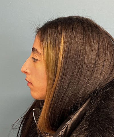 Rhinoplasty Before & After Gallery - Patient 373242 - Image 1