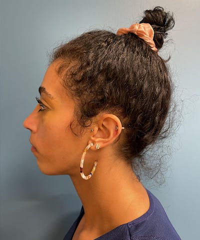 Rhinoplasty Before & After Gallery - Patient 373242 - Image 2