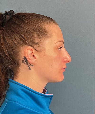 Rhinoplasty Before & After Gallery - Patient 421516 - Image 1