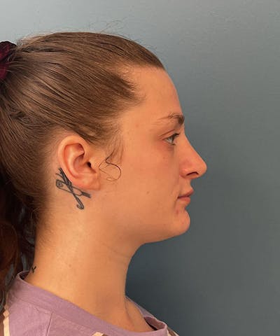Rhinoplasty Before & After Gallery - Patient 421516 - Image 2