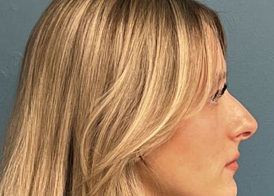 Rhinoplasty Before & After Gallery - Patient 426612 - Image 1