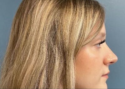 Rhinoplasty Before & After Gallery - Patient 426612 - Image 2