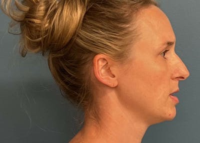 Rhinoplasty Before & After Gallery - Patient 489343 - Image 1