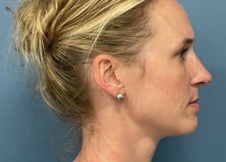 Rhinoplasty Before & After Gallery - Patient 489343 - Image 2