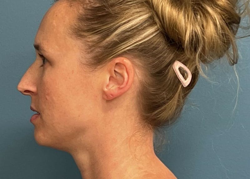 Rhinoplasty Before & After Gallery - Patient 489343 - Image 3