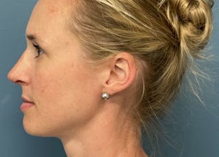 Rhinoplasty Before & After Gallery - Patient 489343 - Image 4