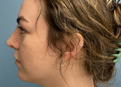 Rhinoplasty Before & After Gallery - Patient 276778 - Image 2