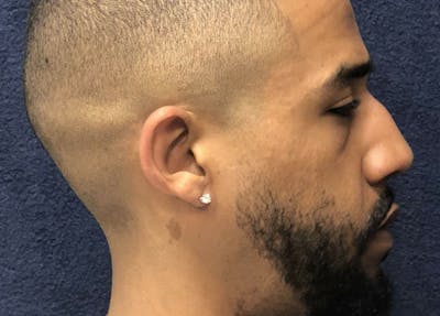 Rhinoplasty Before & After Gallery - Patient 238841 - Image 1