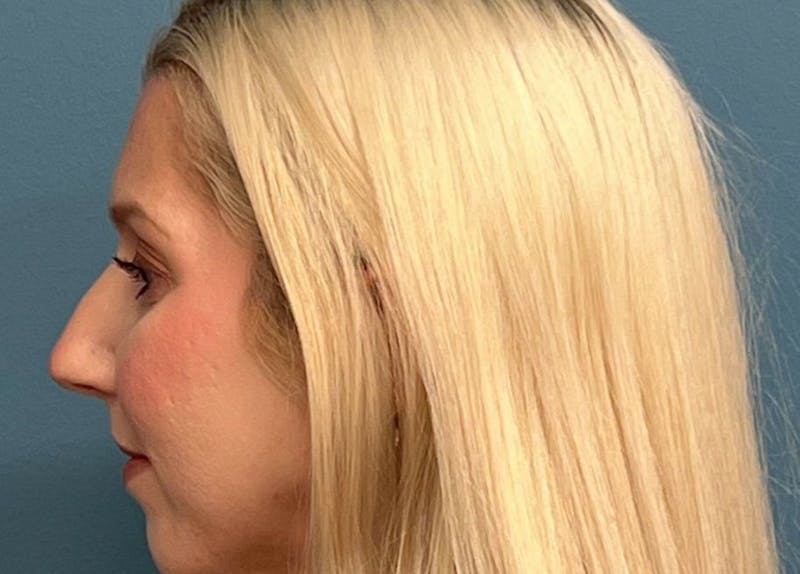 Rhinoplasty Before & After Gallery - Patient 750403 - Image 1