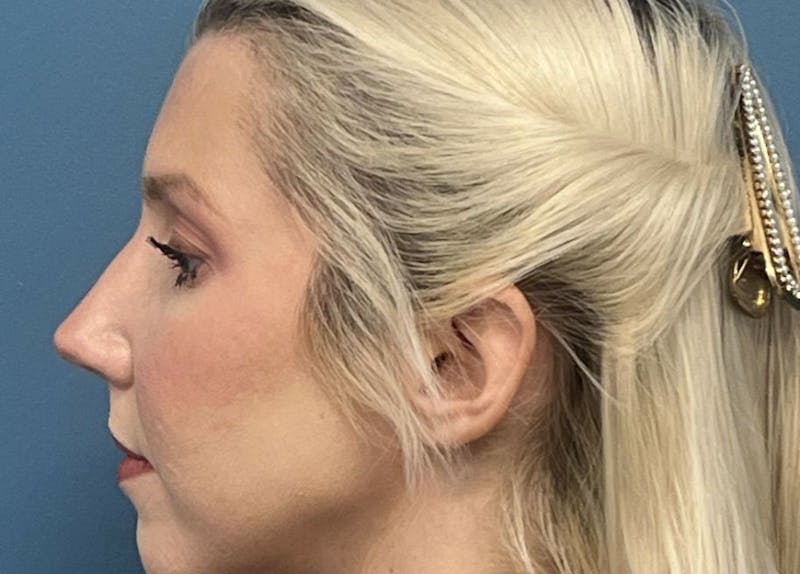 Rhinoplasty Before & After Gallery - Patient 750403 - Image 2