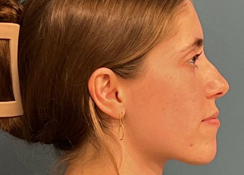 Rhinoplasty Before & After Gallery - Patient 104699 - Image 1