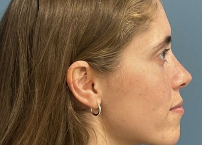 Rhinoplasty Before & After Gallery - Patient 104699 - Image 2