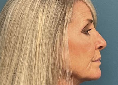 Rhinoplasty Before & After Gallery - Patient 102506 - Image 1