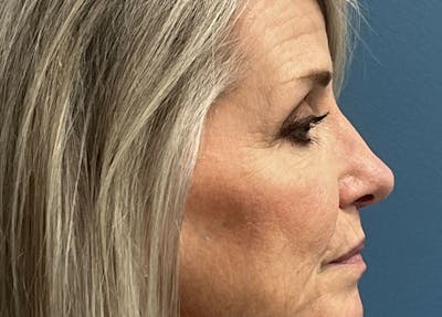 Rhinoplasty Before & After Gallery - Patient 102506 - Image 2