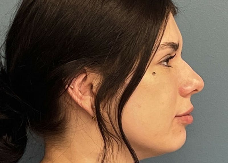 Rhinoplasty Before & After Gallery - Patient 405161 - Image 1