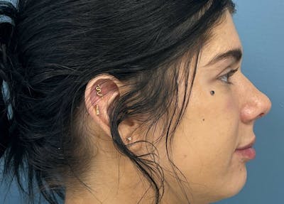 Rhinoplasty Before & After Gallery - Patient 405161 - Image 2