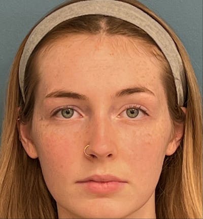 Rhinoplasty Before & After Gallery - Patient 396723 - Image 1