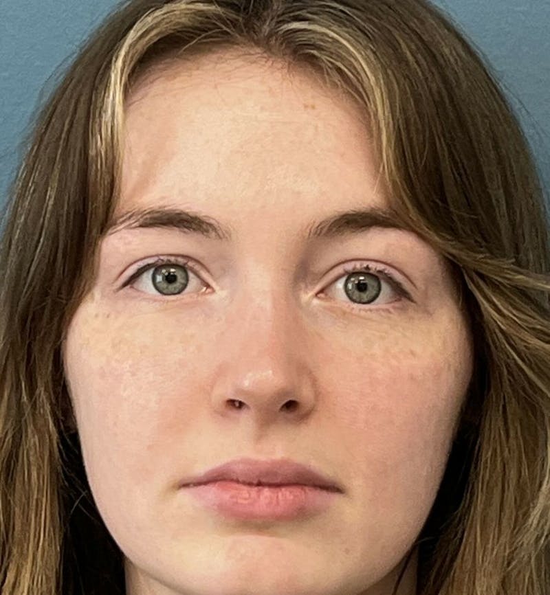 Rhinoplasty Before & After Gallery - Patient 396723 - Image 2