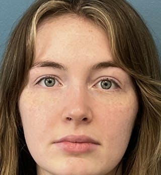 Rhinoplasty Before & After Gallery - Patient 396723 - Image 2