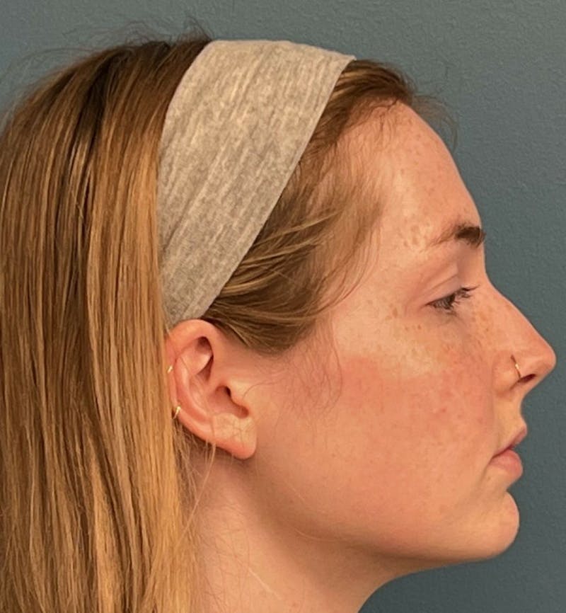 Rhinoplasty Before & After Gallery - Patient 396723 - Image 3