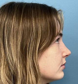 Rhinoplasty Before & After Gallery - Patient 396723 - Image 4