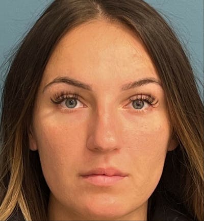 Rhinoplasty Before & After Gallery - Patient 339711 - Image 1
