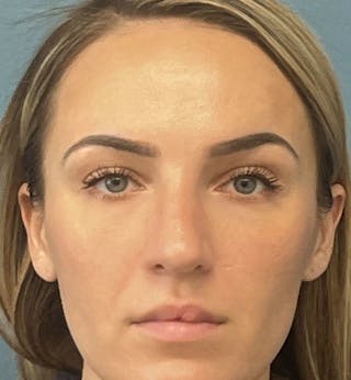 Rhinoplasty Before & After Gallery - Patient 339711 - Image 2
