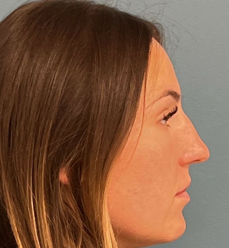 Rhinoplasty Before & After Gallery - Patient 339711 - Image 3
