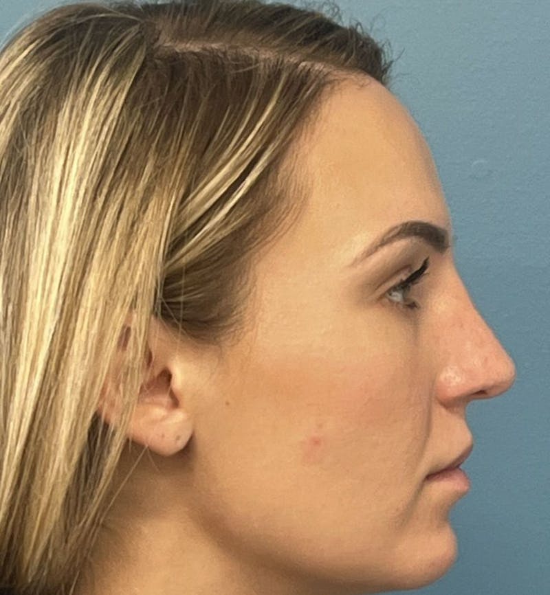 Rhinoplasty Before & After Gallery - Patient 339711 - Image 4