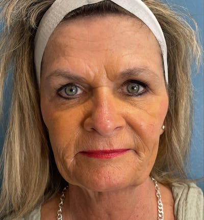 Sculptra for the Face Before & After Gallery - Patient 283795 - Image 1