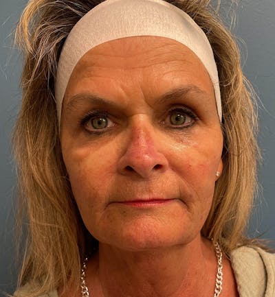 Sculptra for the Face Before & After Gallery - Patient 283795 - Image 2