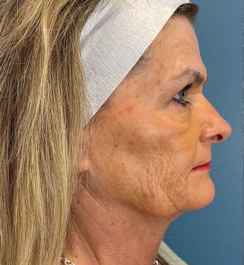 Sculptra for the Face Before & After Gallery - Patient 283795 - Image 3
