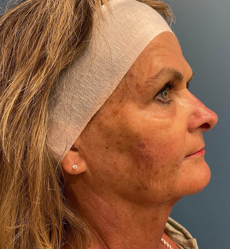 Sculptra for the Face Before & After Gallery - Patient 283795 - Image 4