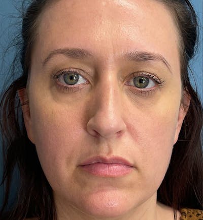 Sculptra for the Face Before & After Gallery - Patient 271715 - Image 1