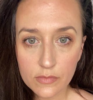 Sculptra for the Face Before & After Gallery - Patient 271715 - Image 2